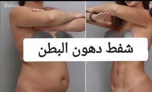 شفط الدهون في ايران