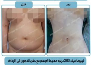نحت الجسم في ايران