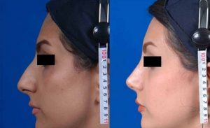 عملية تجميل الأنف في ايران
