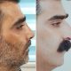 عملية تجميل الأنف في ايران